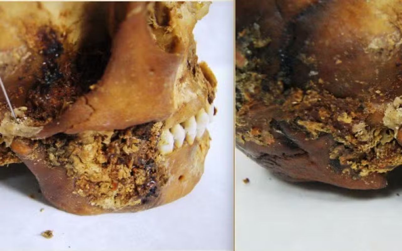 Descoberta de múmia na Sibéria mostra prótese na boca instalada após grave trauma há 2,5 mil anos e revela avanço médico inesperado.